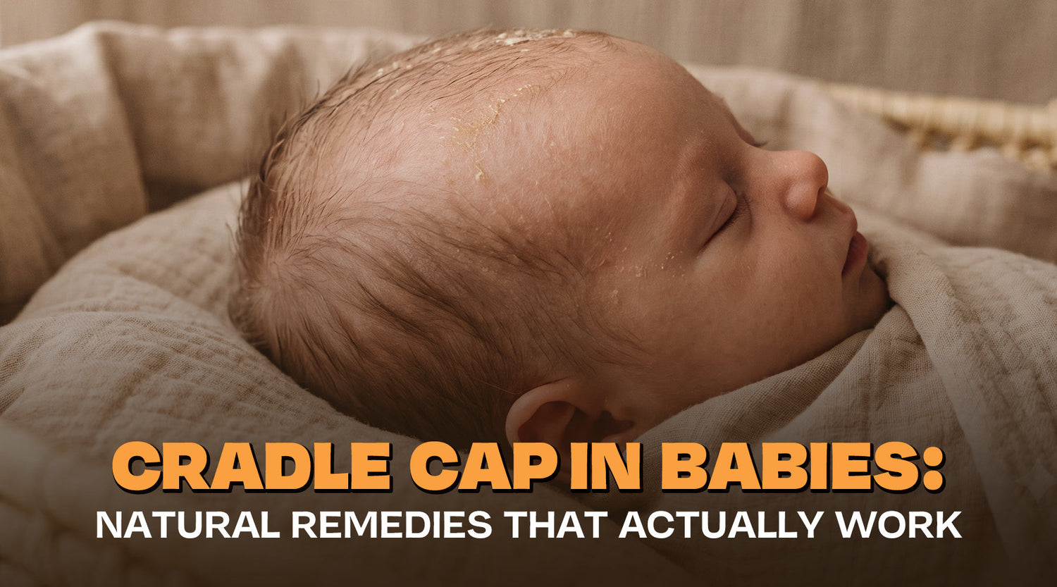Cradle Cap in Babies